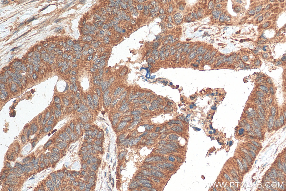 Immunohistochemistry (IHC) staining of human colon cancer tissue using DEFB1 Polyclonal antibody (14738-1-AP)