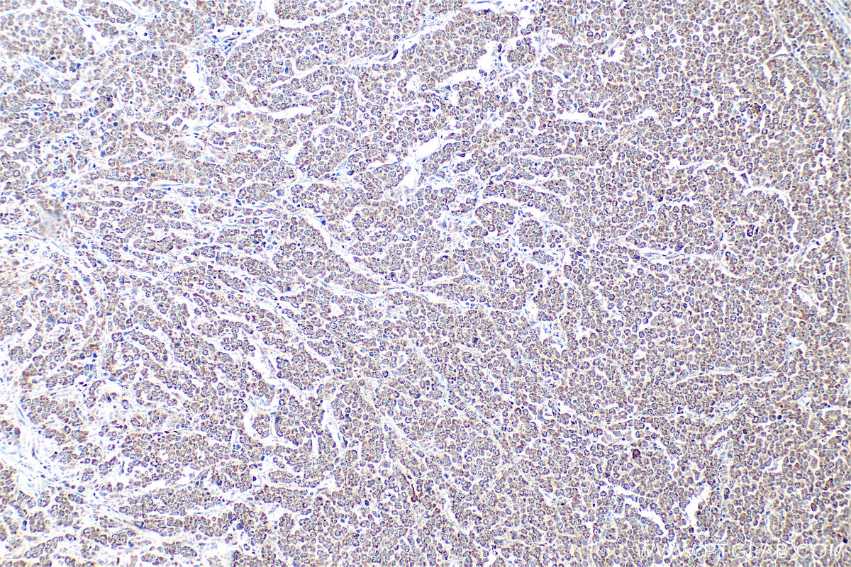 Immunohistochemical analysis of paraffin-embedded human colon cancer tissue slide using 14738-1-AP (DEFB1 antibody) at dilution of 1:400 (under 10x lens). Heat mediated antigen retrieval with Tris-EDTA buffer (pH 9.0). Immunohistochemistry (IHC) staining of human colon cancer tissue using DEFB1 Polyclonal antibody (14738-1-AP)