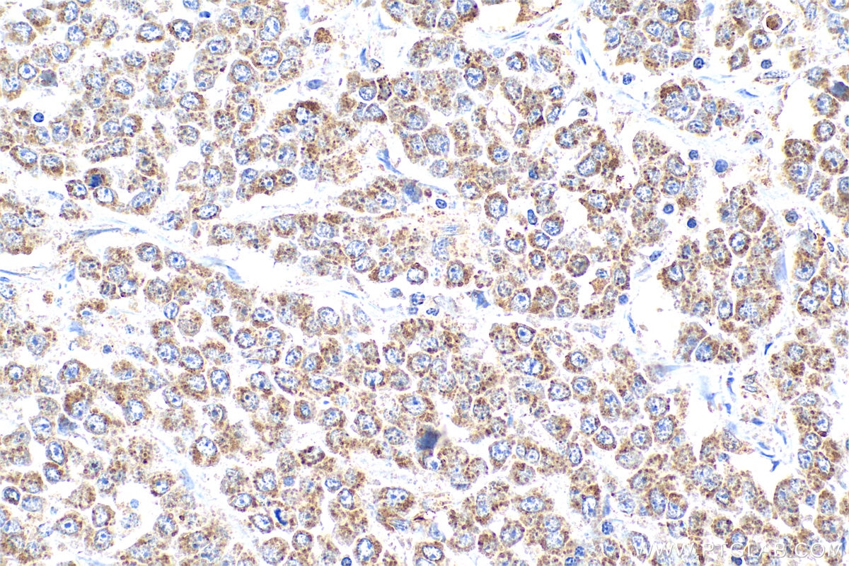 Immunohistochemistry (IHC) staining of human colon cancer tissue using DEFB1 Polyclonal antibody (14738-1-AP)