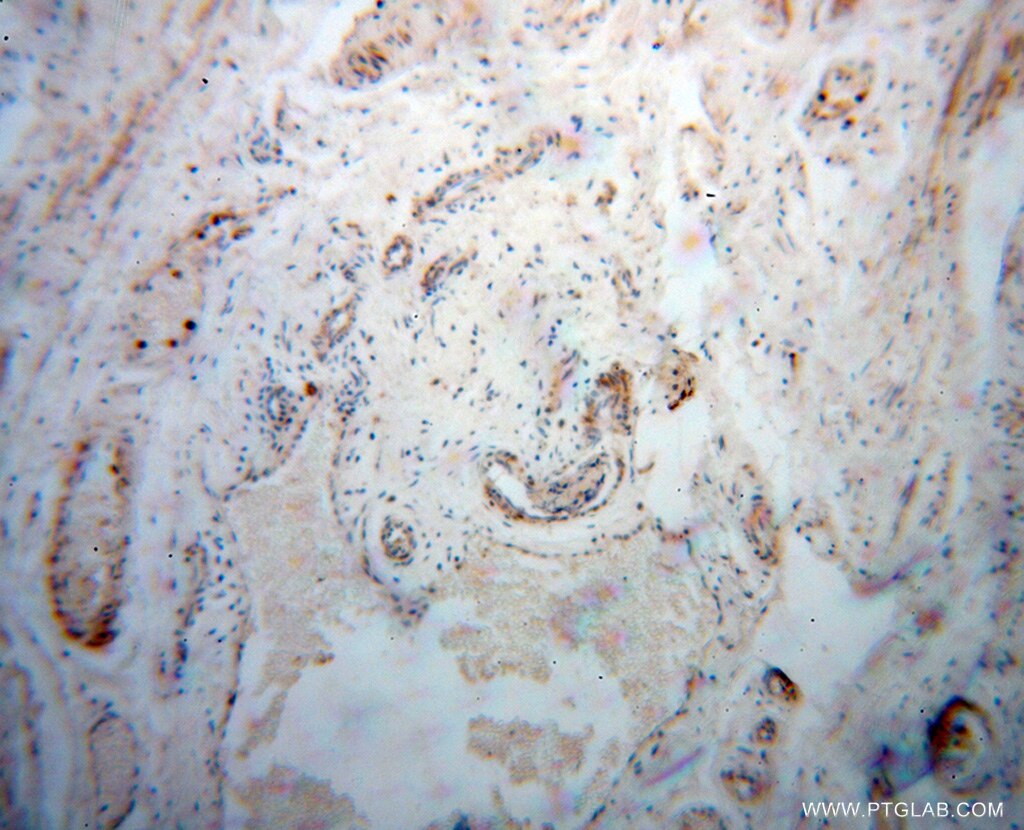Immunohistochemistry (IHC) staining of human colon cancer tissue using DEFB1 Polyclonal antibody (14738-1-AP)