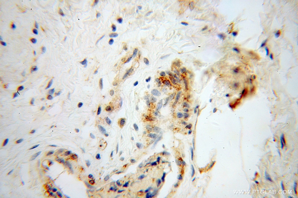 IHC staining of human colon cancer using 14738-1-AP