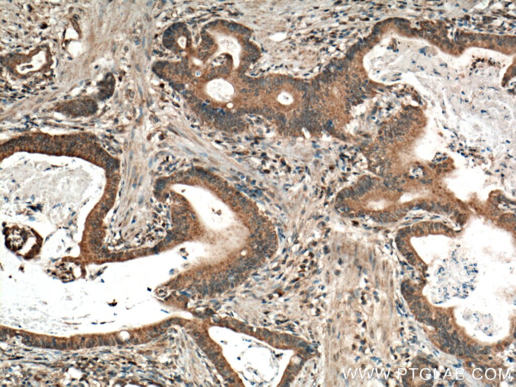 Immunohistochemistry (IHC) staining of human stomach cancer tissue using DEFB121 Polyclonal antibody (25761-1-AP)