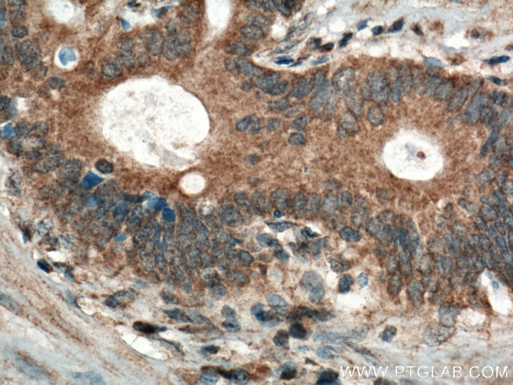 Immunohistochemistry (IHC) staining of human stomach cancer tissue using DEFB121 Polyclonal antibody (25761-1-AP)