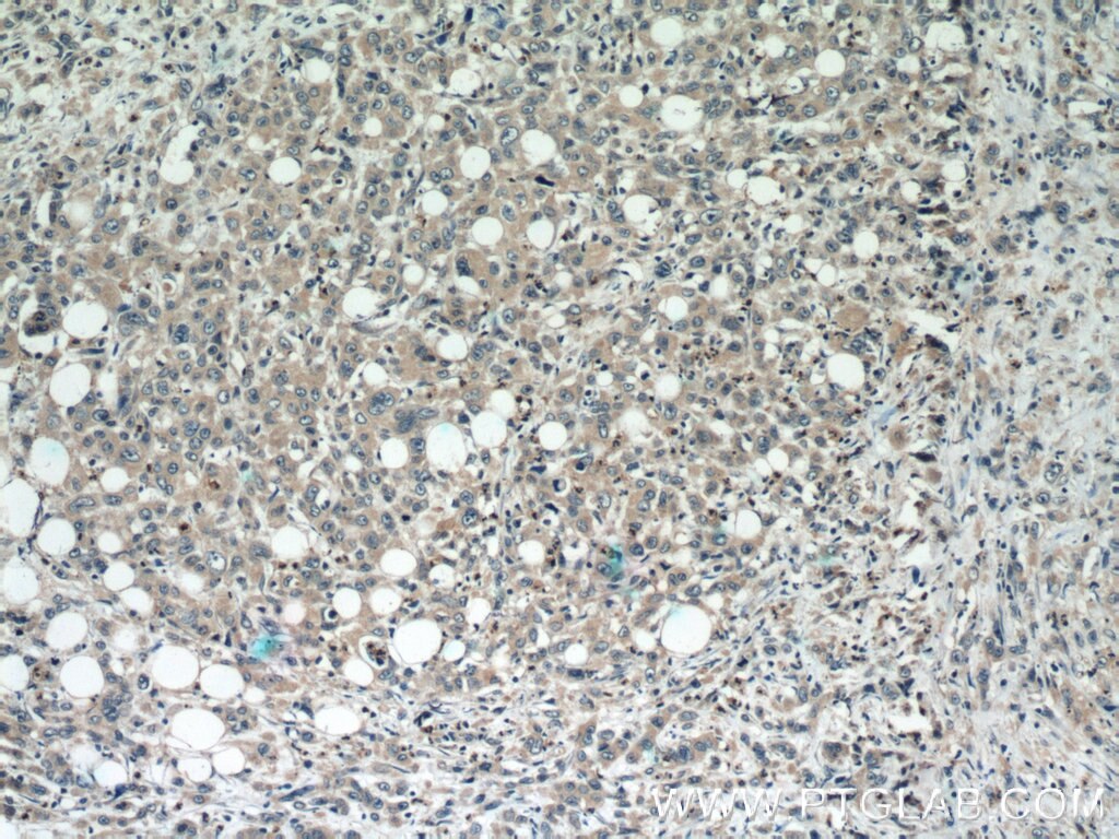 Immunohistochemistry (IHC) staining of human stomach cancer tissue using DEFB121 Polyclonal antibody (25761-1-AP)