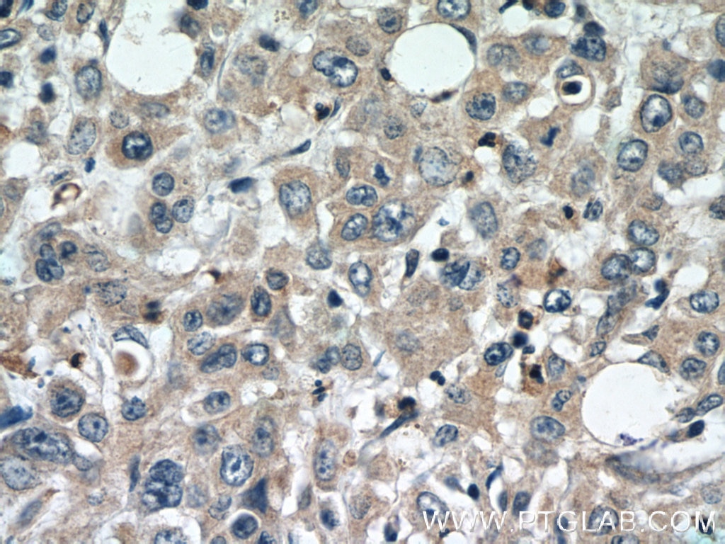 Immunohistochemistry (IHC) staining of human stomach cancer tissue using DEFB121 Polyclonal antibody (25761-1-AP)