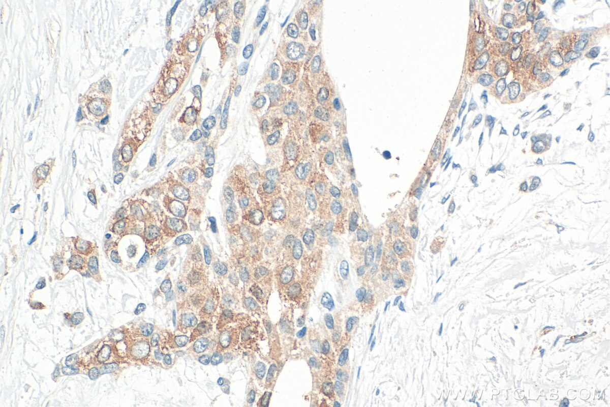 IHC staining of human urothelial carcinoma using 33219-1-AP Immunohistochemistry (IHC) staining of human urothelial carcinoma tissue using DEFB132 Polyclonal antibody (33219-1-AP)