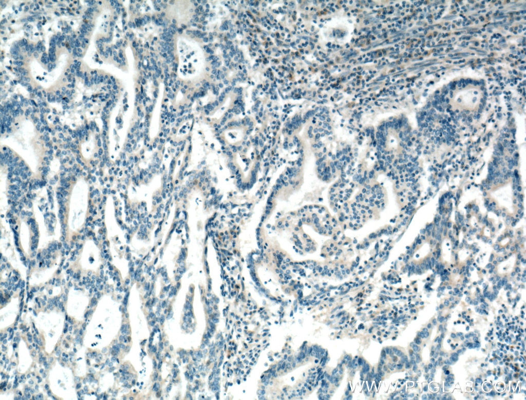Immunohistochemistry (IHC) staining of human endometrial cancer tissue using DENND1A Polyclonal antibody (25658-1-AP)