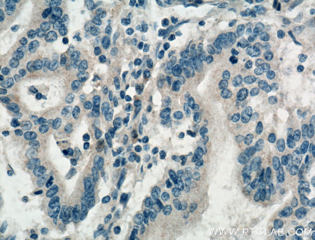 Immunohistochemistry (IHC) staining of human endometrial cancer tissue using DENND1A Polyclonal antibody (25658-1-AP)