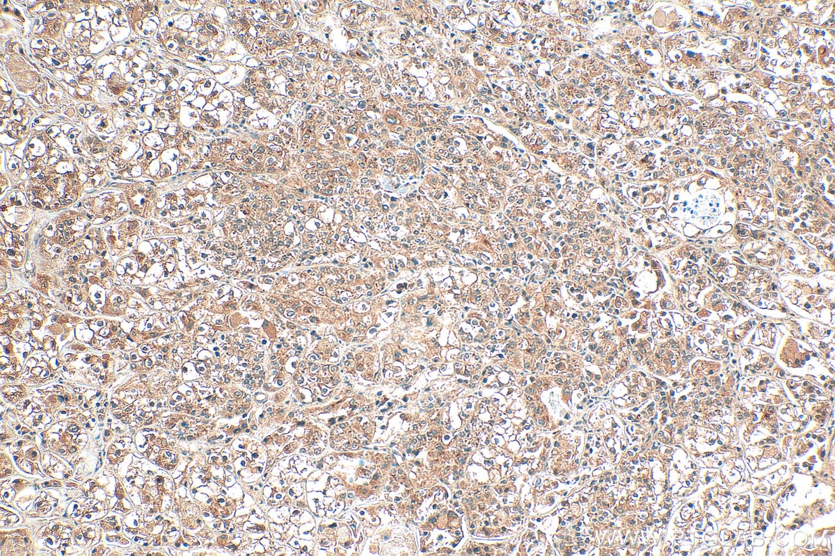Immunohistochemistry (IHC) staining of human endometrial cancer tissue using DENND1A Polyclonal antibody (25658-1-AP)