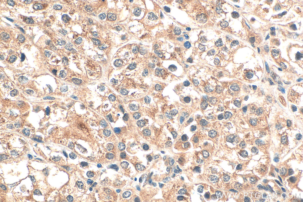 Immunohistochemistry (IHC) staining of human endometrial cancer tissue using DENND1A Polyclonal antibody (25658-1-AP)