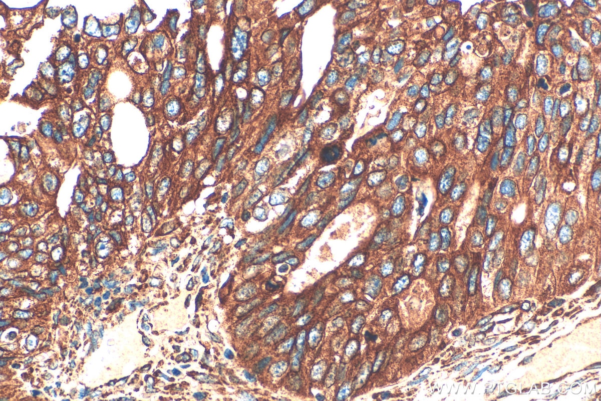 Immunohistochemistry (IHC) staining of human ovary tumor tissue using DENND2D Polyclonal antibody (33113-1-AP)