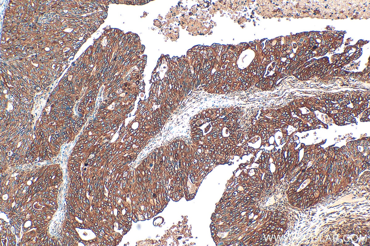 Immunohistochemistry (IHC) staining of human ovary tumor tissue using DENND2D Polyclonal antibody (33113-1-AP)