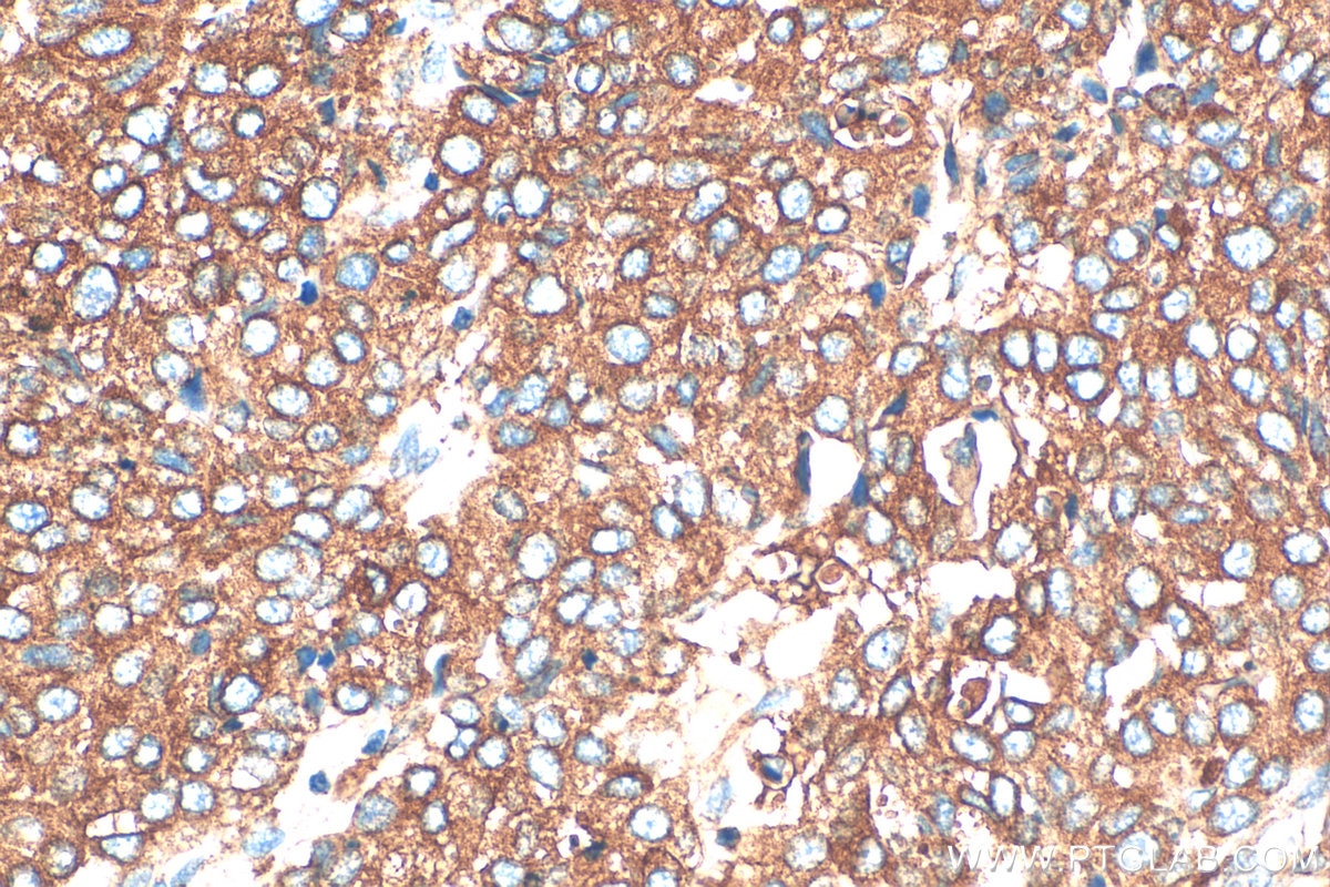 Immunohistochemistry (IHC) staining of human stomach cancer tissue using DENND2D Polyclonal antibody (33113-1-AP)