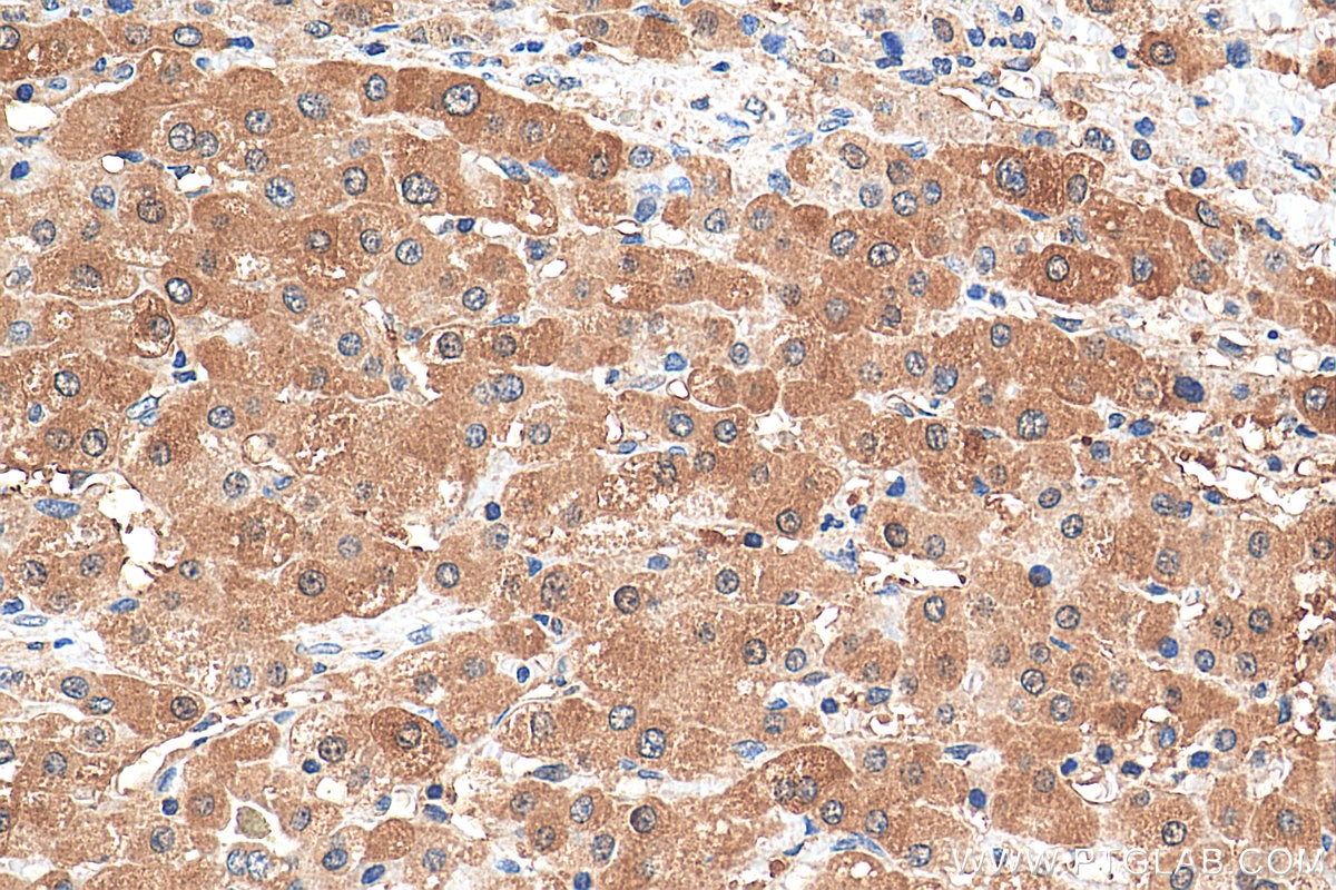 Immunohistochemistry (IHC) staining of human liver cancer tissue using DENR Polyclonal antibody (10656-1-AP)