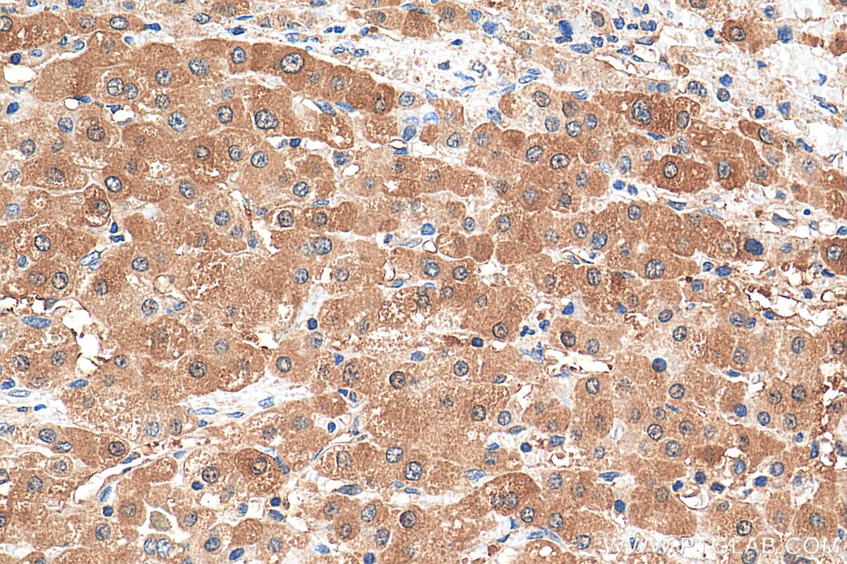 IHC staining of human liver cancer using 10656-1-AP