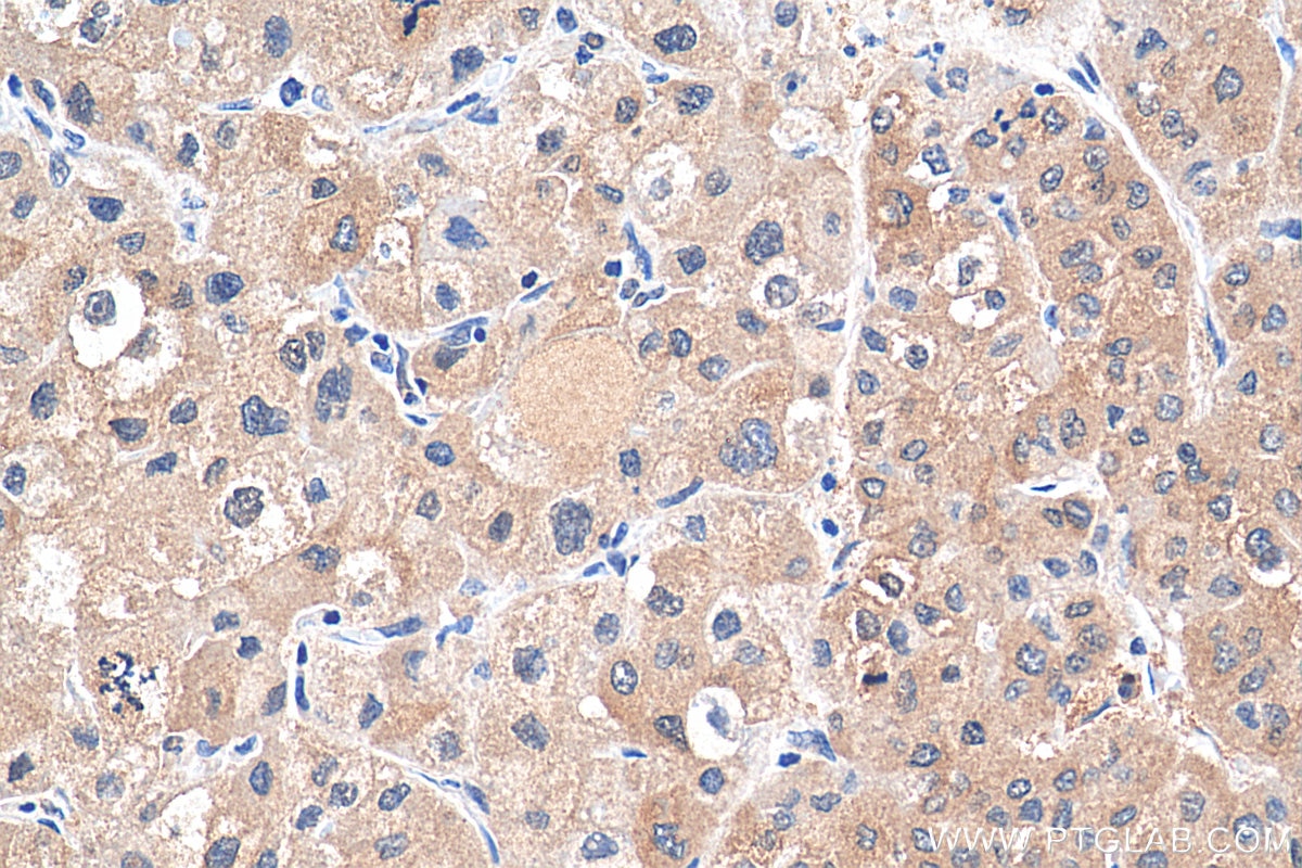 Immunohistochemistry (IHC) staining of human liver cancer tissue using DENR Polyclonal antibody (10656-1-AP)