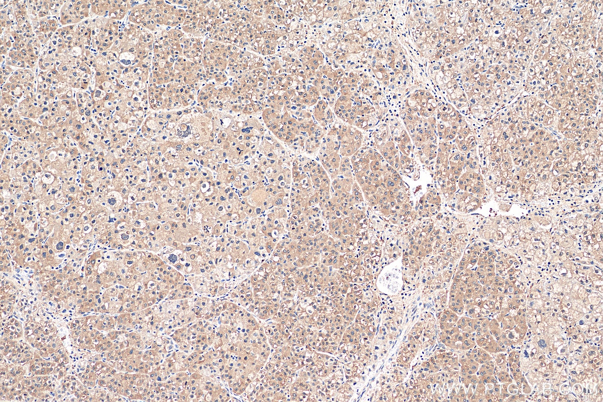 Immunohistochemistry (IHC) staining of human liver cancer tissue using DENR Polyclonal antibody (10656-1-AP)