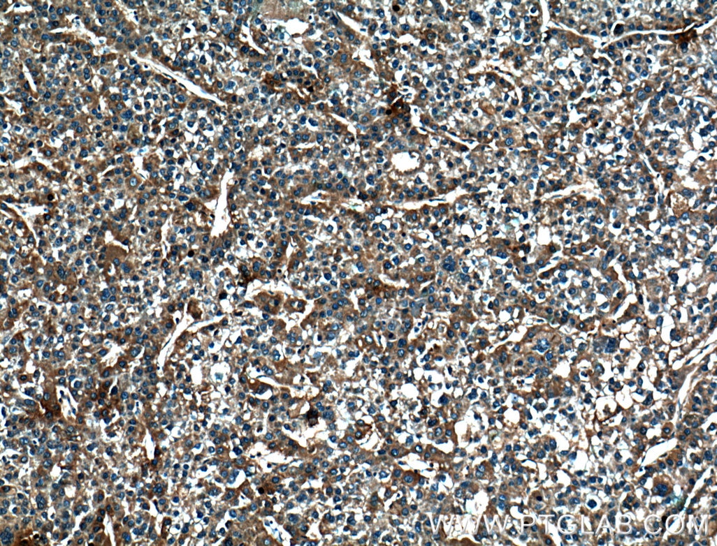 Immunohistochemistry (IHC) staining of human liver cancer tissue using DEPDC6/Deptor Polyclonal antibody (20985-1-AP)