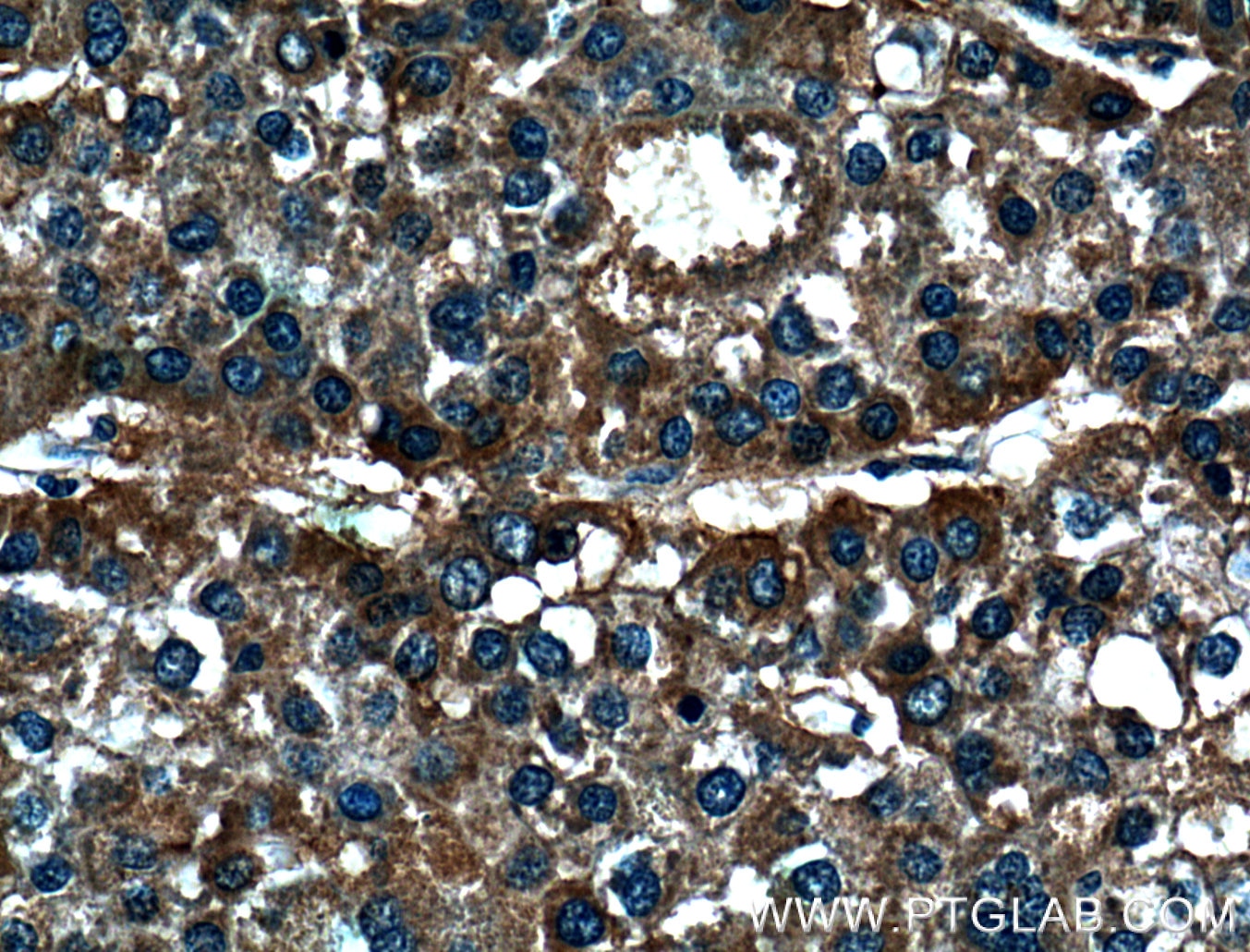 Immunohistochemistry (IHC) staining of human liver cancer tissue using DEPDC6/Deptor Polyclonal antibody (20985-1-AP)