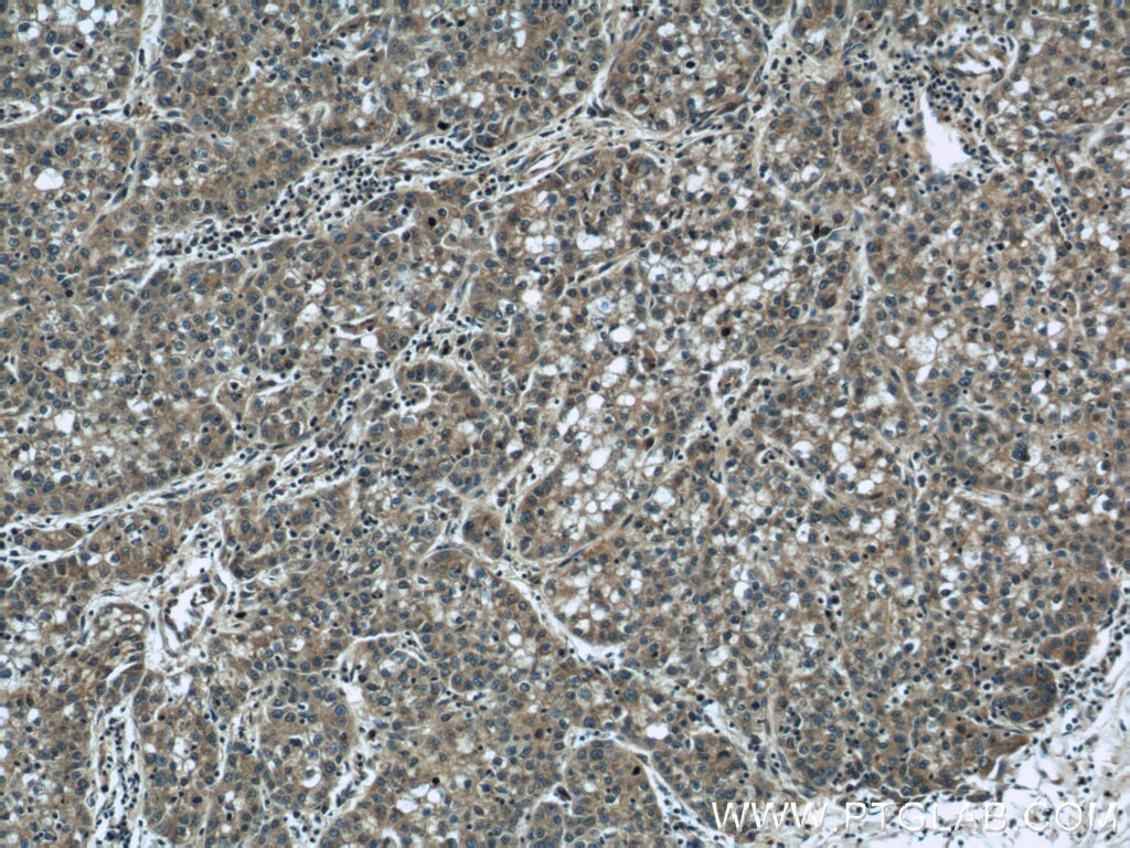 Immunohistochemistry (IHC) staining of human liver cancer tissue using DEPDC6/Deptor Polyclonal antibody (20985-1-AP)