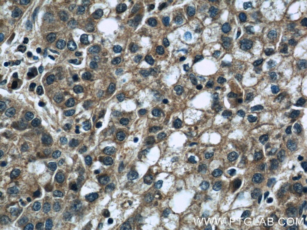 Immunohistochemistry (IHC) staining of human liver cancer tissue using DEPDC6/Deptor Polyclonal antibody (20985-1-AP)