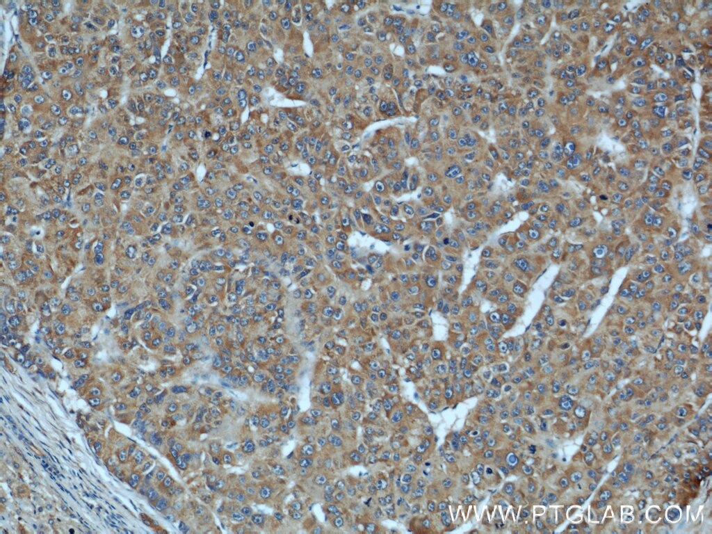 Immunohistochemistry (IHC) staining of human liver cancer tissue using DEPDC6/Deptor Polyclonal antibody (20985-1-AP)