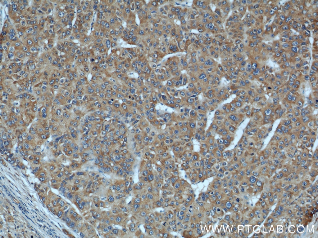 IHC staining of human liver cancer using 20985-1-AP