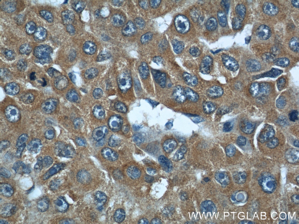 Immunohistochemistry (IHC) staining of human liver cancer tissue using DEPDC6/Deptor Polyclonal antibody (20985-1-AP)