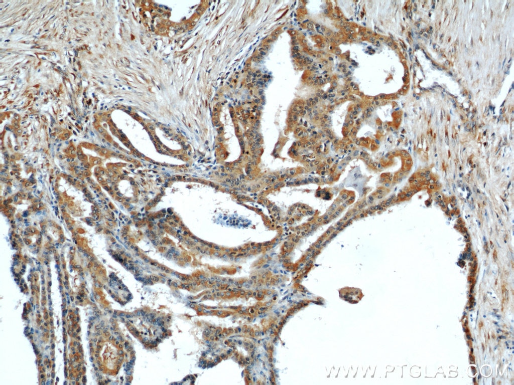 Immunohistochemistry (IHC) staining of human thyroid cancer tissue using DEPDC6/Deptor Polyclonal antibody (20985-1-AP)