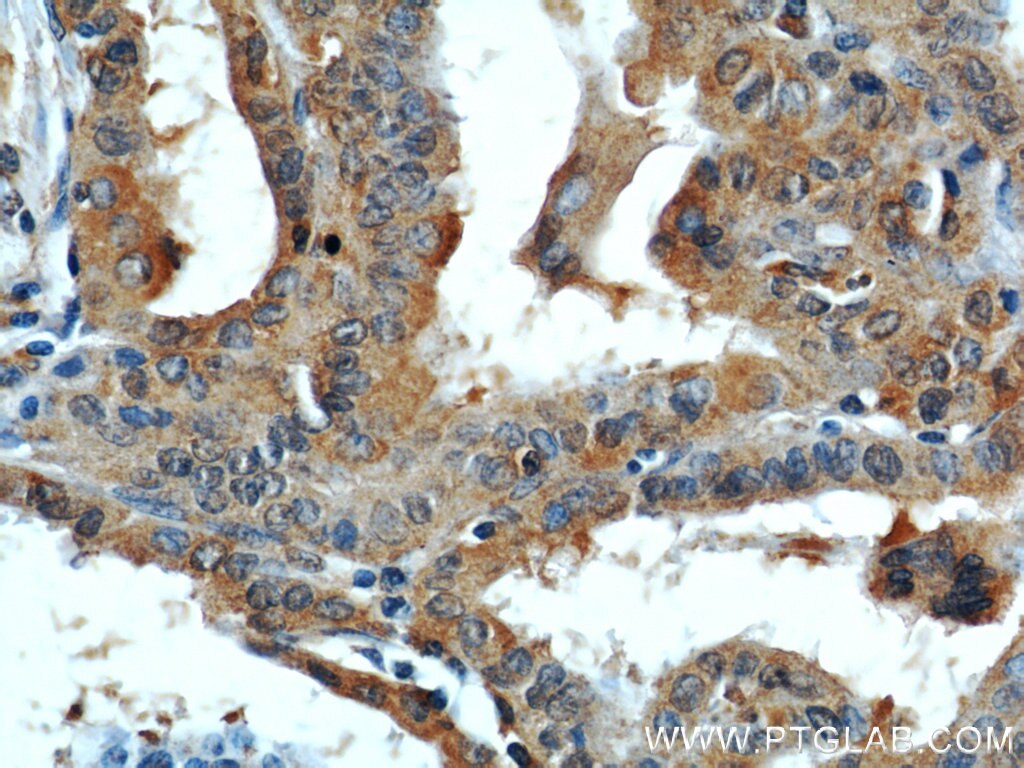 Immunohistochemistry (IHC) staining of human thyroid cancer tissue using DEPDC6/Deptor Polyclonal antibody (20985-1-AP)