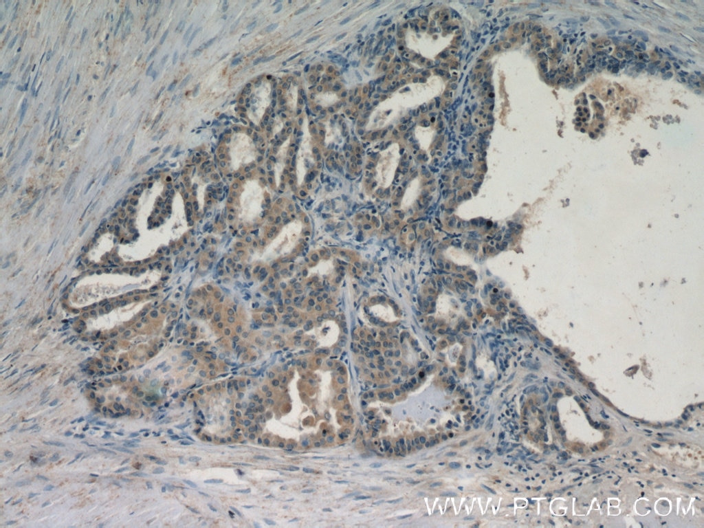 Immunohistochemistry (IHC) staining of human thyroid cancer tissue using DEPDC6 Polyclonal antibody (21312-1-AP)