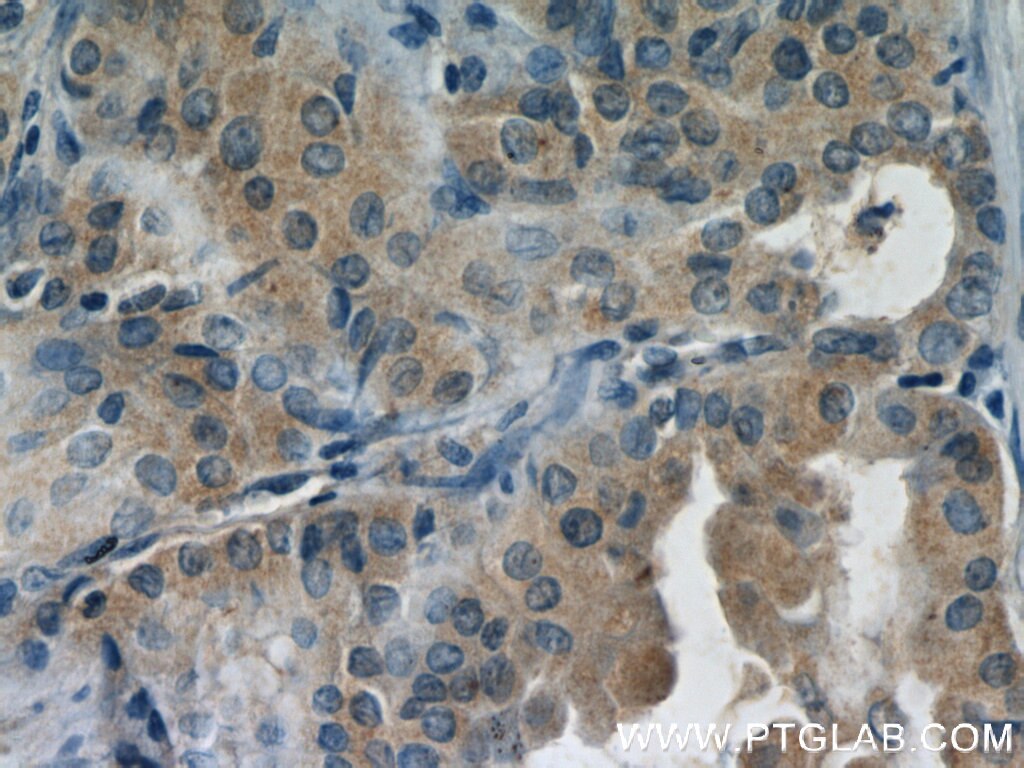 Immunohistochemistry (IHC) staining of human thyroid cancer tissue using DEPDC6 Polyclonal antibody (21312-1-AP)