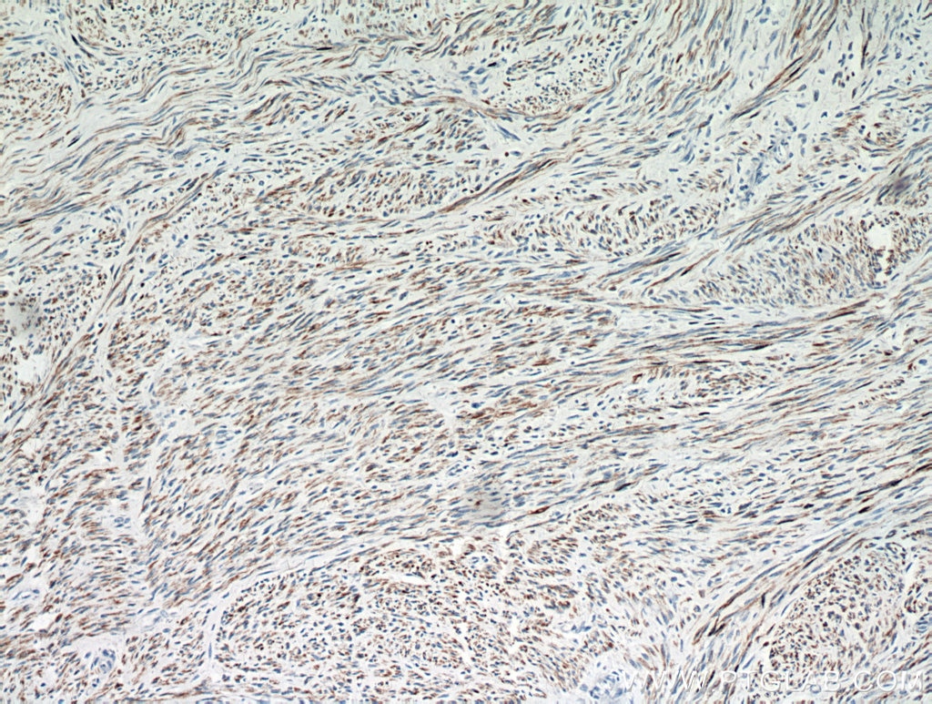 Immunohistochemistry (IHC) staining of human hysteromyoma tissue using Desmin Polyclonal antibody (16520-1-AP)