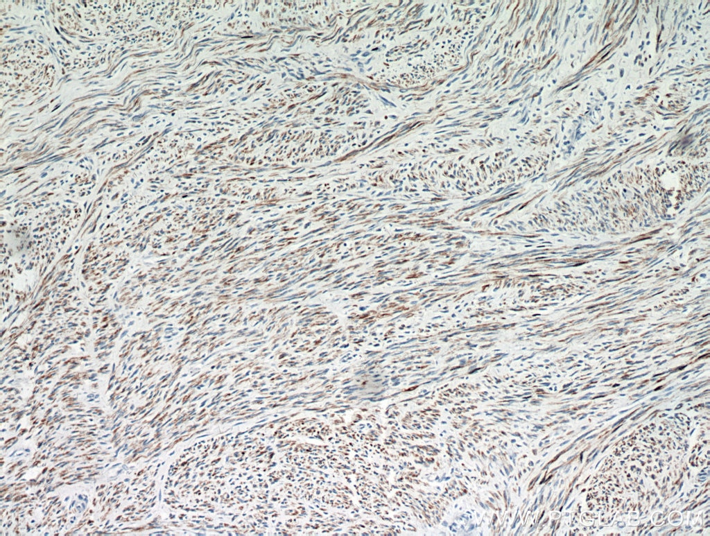 IHC staining of human hysteromyoma using 16520-1-AP