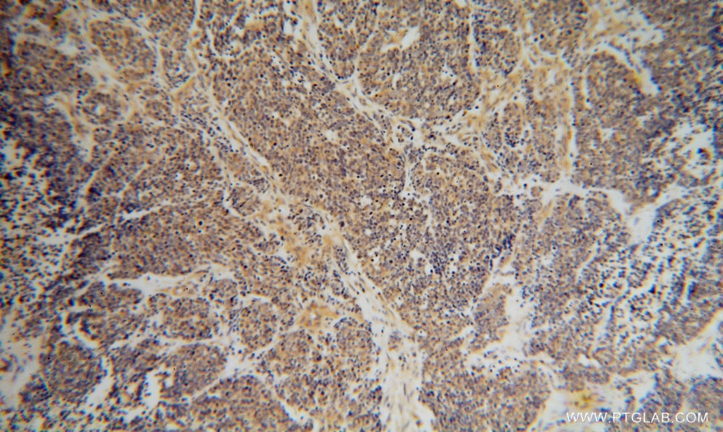 IHC staining of human lung cancer using 14811-1-AP