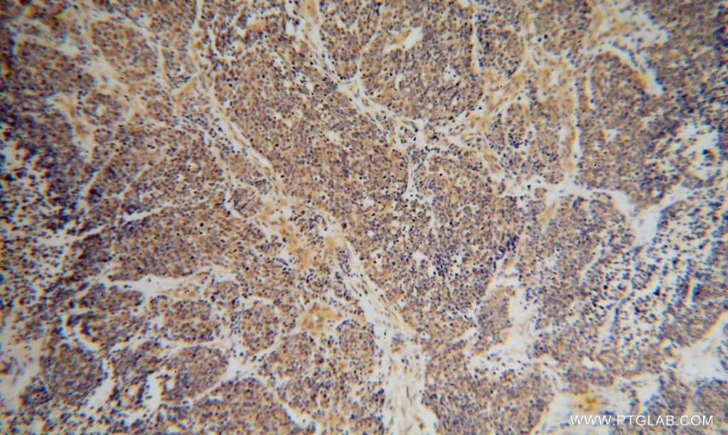 Immunohistochemistry (IHC) staining of human lung cancer tissue using DEXI Polyclonal antibody (14811-1-AP)