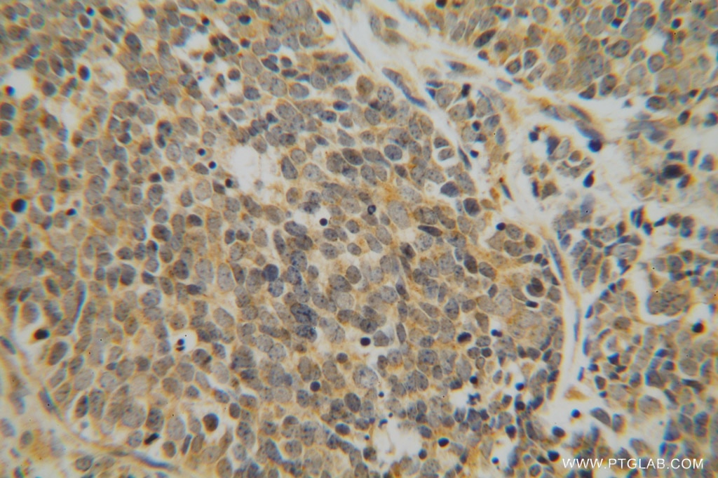 Immunohistochemistry (IHC) staining of human lung cancer tissue using DEXI Polyclonal antibody (14811-1-AP)