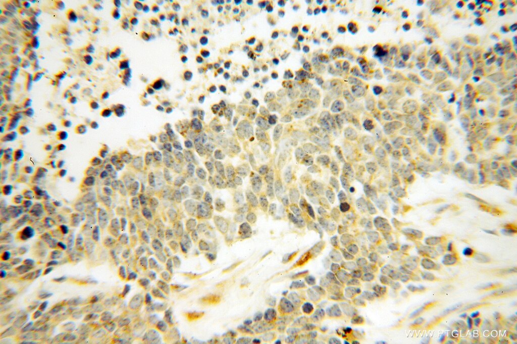 Immunohistochemistry (IHC) staining of human lung cancer tissue using DEXI Polyclonal antibody (14811-1-AP)