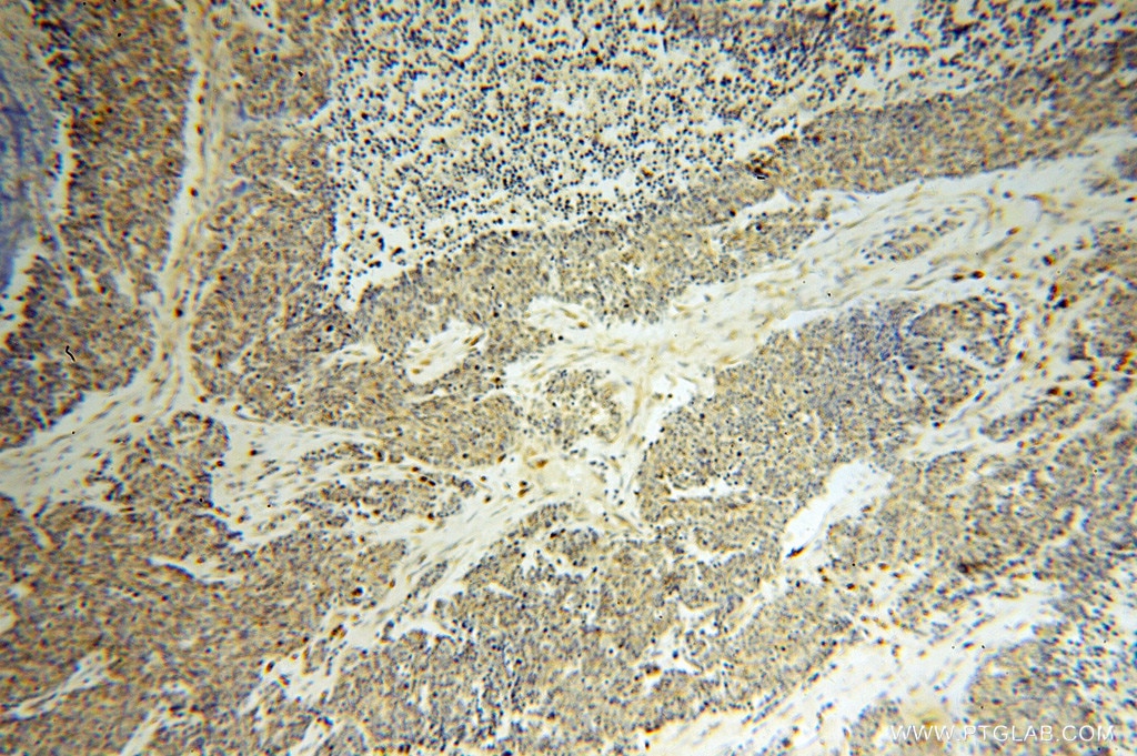 Immunohistochemistry (IHC) staining of human lung cancer tissue using DEXI Polyclonal antibody (14811-1-AP)