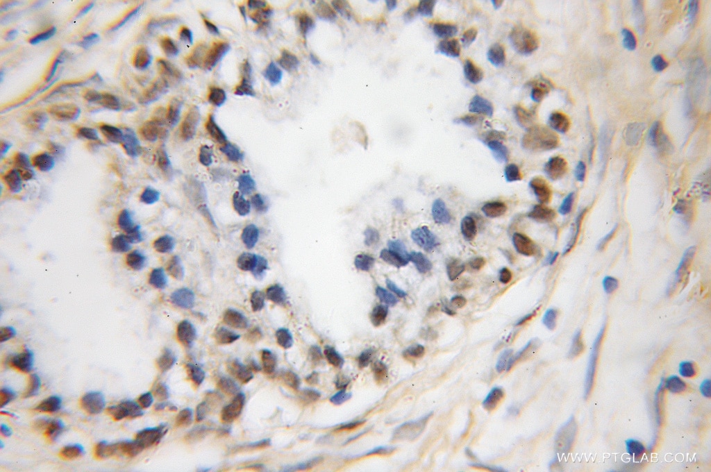 Immunohistochemistry (IHC) staining of human prostate cancer tissue using DFF45/DFFA Polyclonal antibody (10191-2-AP)