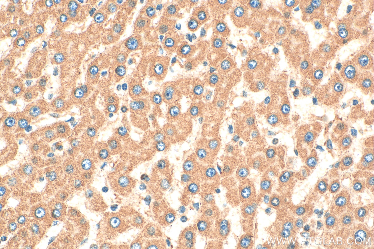 Immunohistochemistry (IHC) staining of human hepatocirrhosis tissue using DGAT1 Polyclonal antibody (11561-1-AP)