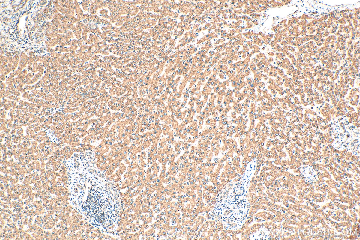Immunohistochemistry (IHC) staining of human hepatocirrhosis tissue using DGAT1 Polyclonal antibody (11561-1-AP)