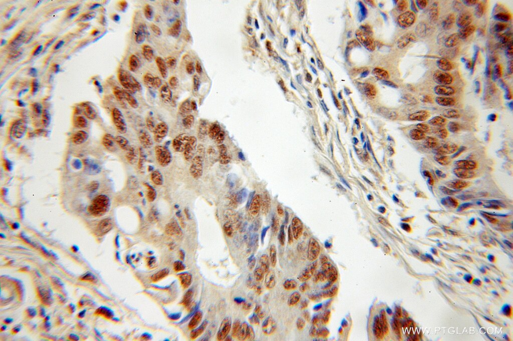 Immunohistochemistry (IHC) staining of human colon cancer tissue using DGCR8 C-terminal Polyclonal antibody (10996-1-AP)