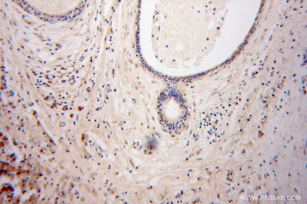 Immunohistochemistry (IHC) staining of human breast cancer tissue using DGCR8 C-terminal Polyclonal antibody (10996-1-AP)