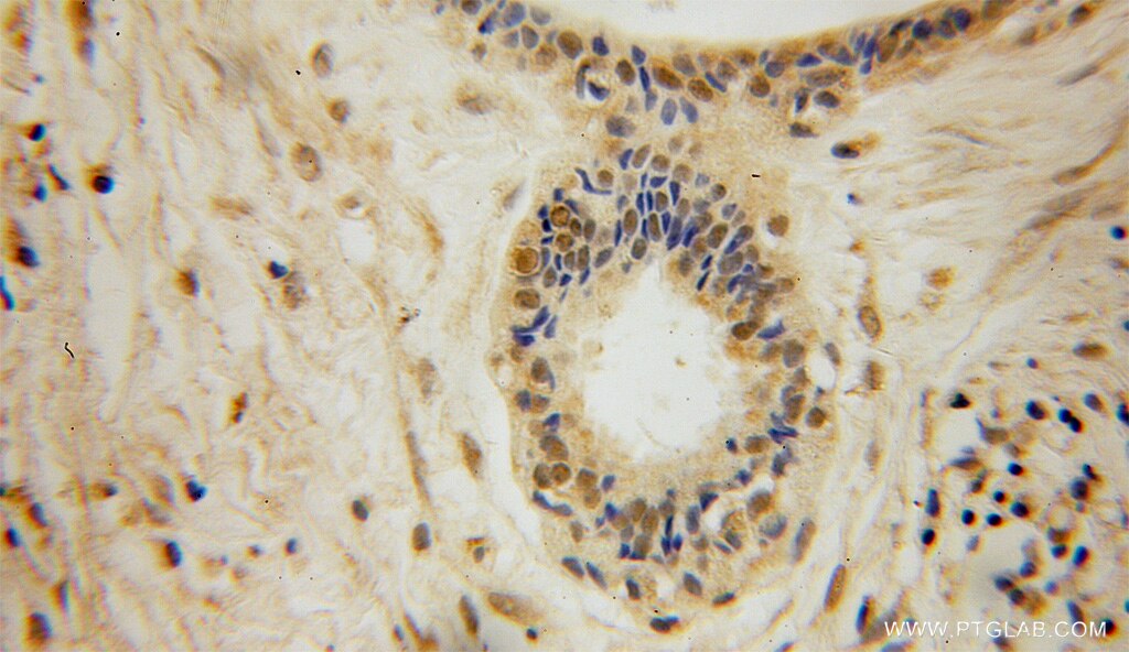 Immunohistochemistry (IHC) staining of human breast cancer tissue using DGCR8 C-terminal Polyclonal antibody (10996-1-AP)