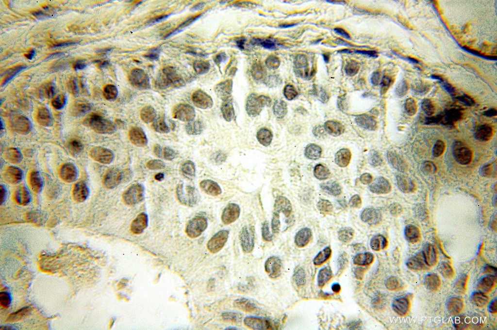 Immunohistochemistry (IHC) staining of human breast cancer tissue using DGCR8 C-terminal Polyclonal antibody (10996-1-AP)