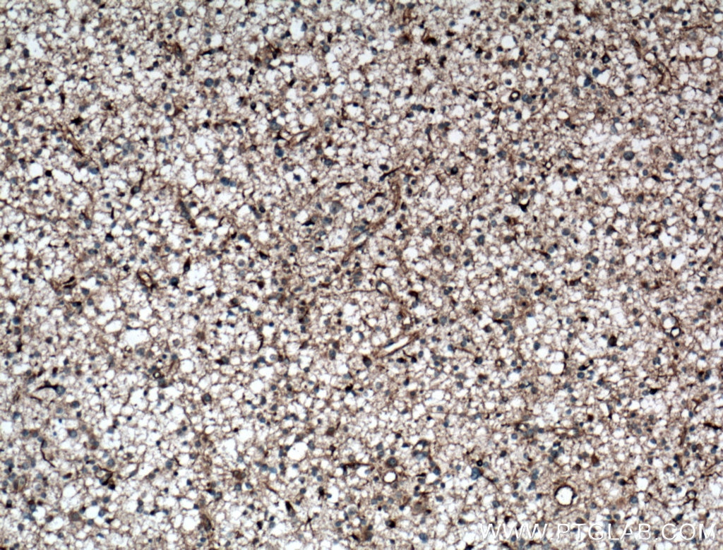 Immunohistochemistry (IHC) staining of human gliomas tissue using DGKA Polyclonal antibody (11547-1-AP)