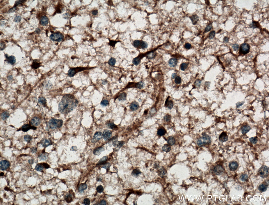 IHC staining of human gliomas using 11547-1-AP