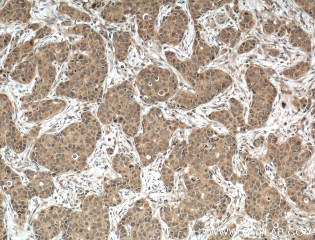 Immunohistochemistry (IHC) staining of human breast cancer tissue using DGKB Polyclonal antibody (24320-1-AP)
