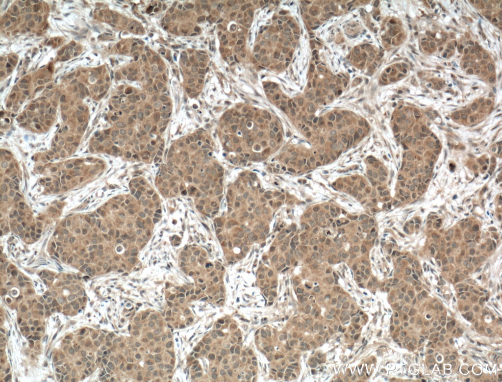 Immunohistochemistry (IHC) staining of human breast cancer tissue using DGKB Polyclonal antibody (24320-1-AP)